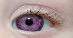 Purple Eye Disease - Symptoms And Causes