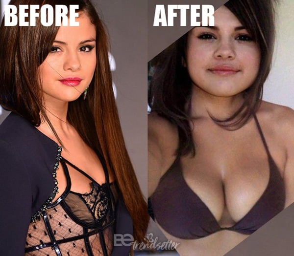 Boob surgery before and after