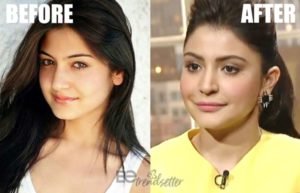 anushka-sharma-lips-before-after | Be Trendsetter