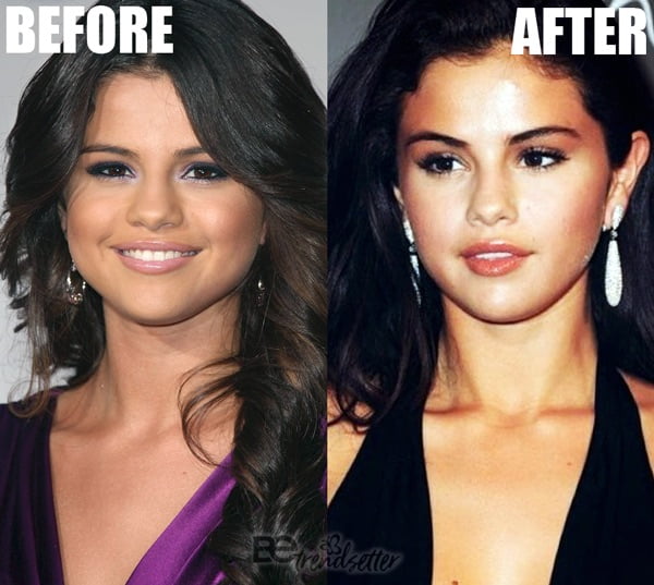 Selena Gomez Plastic Surgery Revealed Before And After