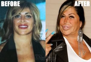 Plastic Surgery Gone Wrong 31 Worst Celebrity Before And After