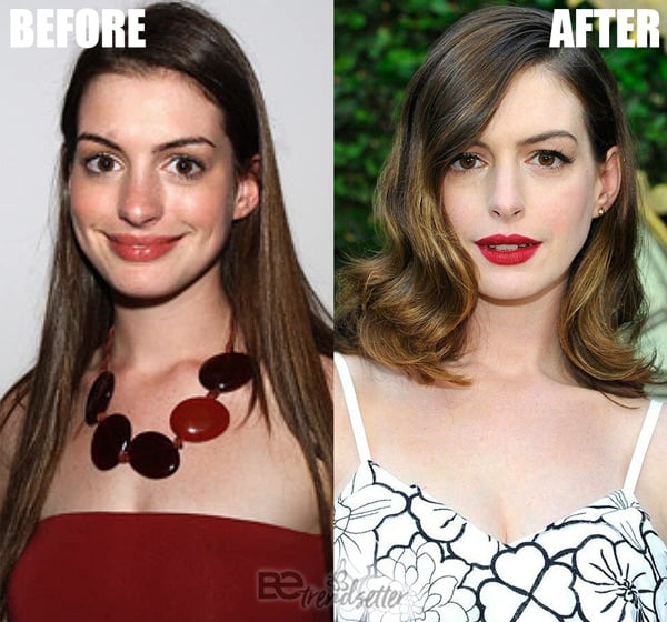 Anne Hathaway's Plastic Surgery Before and After